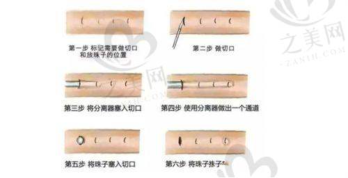 显微吸脂技术特点