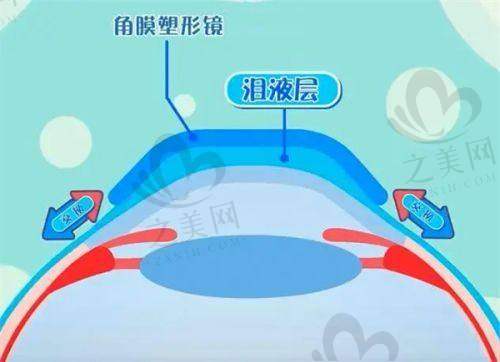 眼科项目价格参考:合理选择手术