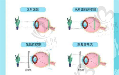 其他眼科项目收费