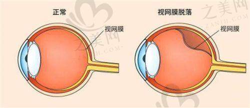 (四)青光眼治疗价格