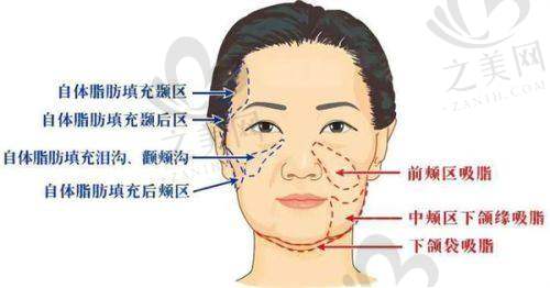 北京联合丽格陈万芳自体脂肪填充怎么样?专业技术与优质效果令人满意!