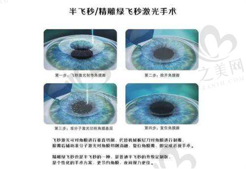 北京民众眼科医院近视手术价格