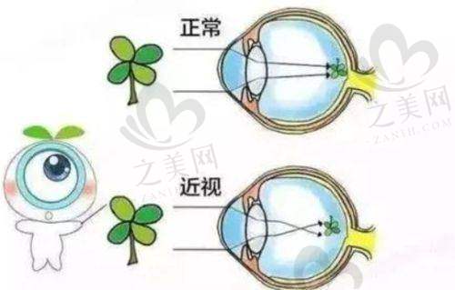 2024 - 2025深圳近视眼手术医院排名前十