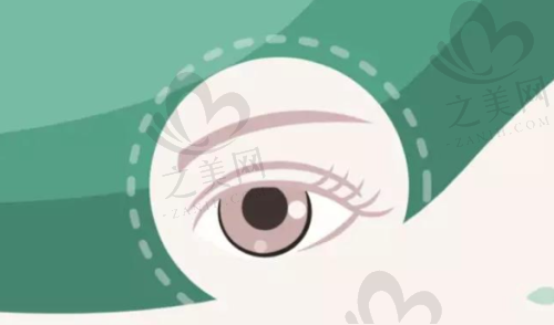 近视矫正项目及价格