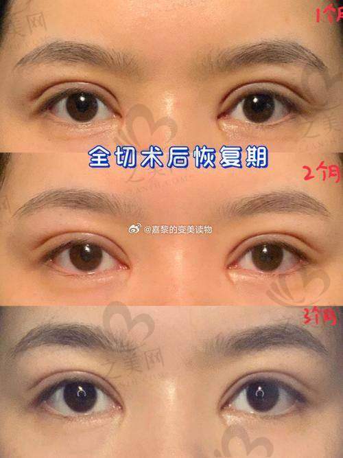上海爱尚丽格张诗若外眦下至技术如何?专业精细,外眦线条自然流畅,术后的修复时间短
