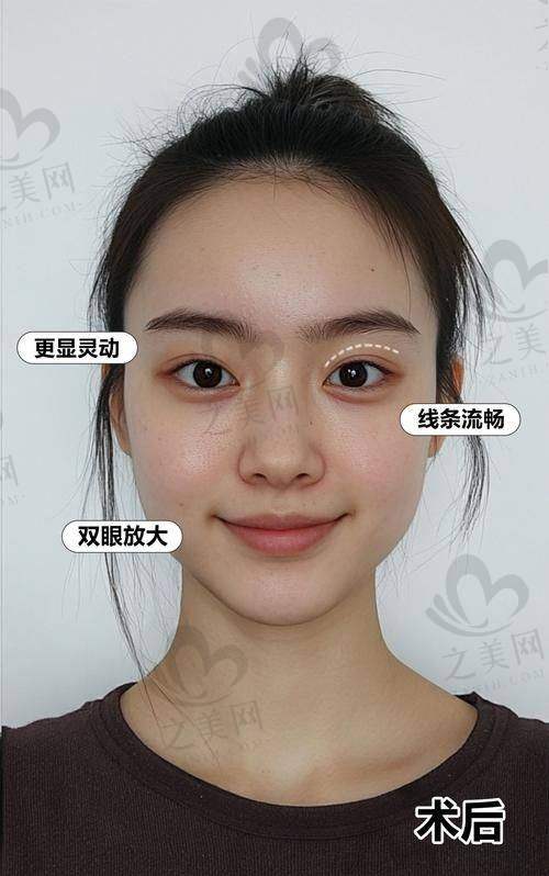 眼综合手术的优势