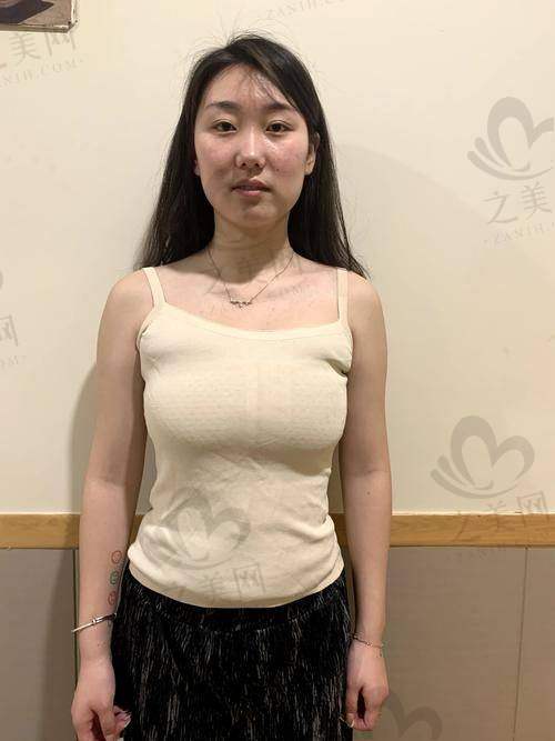 广州君美王世虎曼托假体丰胸价格:在26000元至100000元之间,术后保持持久的形状和丰满度
