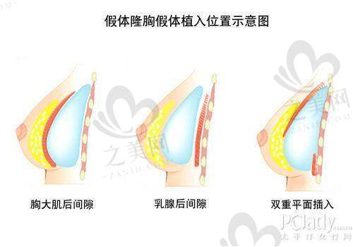 遵义利美康整形口腔医院假体隆胸使用的假体品牌