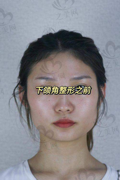 面部骨骼不对称做下巴截骨手术矫正要多少钱
