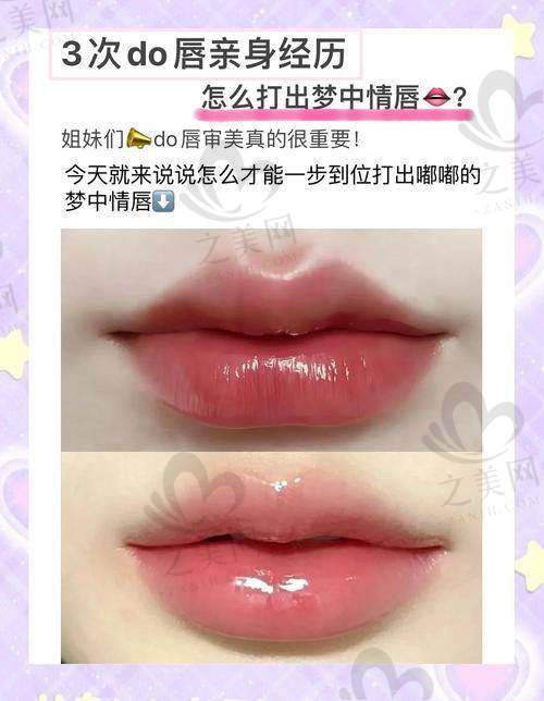 玻尿酸丰唇价格探讨