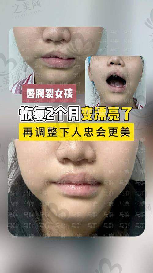 青岛做嘴唇一般花多少钱?唇部整形医院了解下,乔雅登丰颜1毫升15800元起
