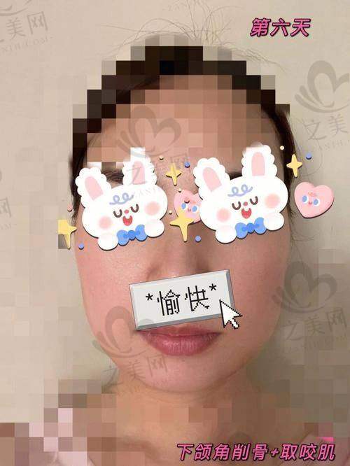 国内正颌磨骨手术价格范围