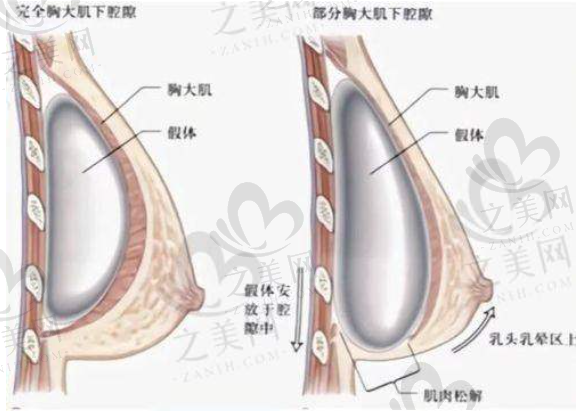 深圳艺星徐英等医生隆胸技术好,深圳美莱/艺星玻尿酸1000-19800元起一支