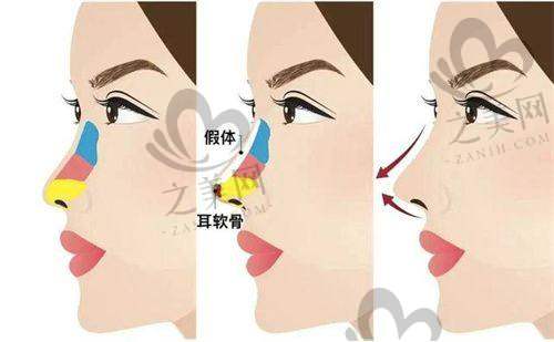 想变美不用愁!深圳宝丽医疗美容隆鼻、吸脂、双眼皮6000元起,院长亲诊速约