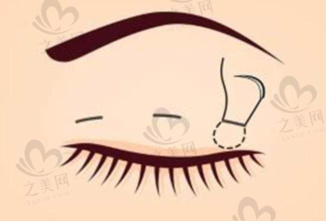 想了解成都纯曦医美林靖医生眼整形价格?林靖双眼皮修复10000元起