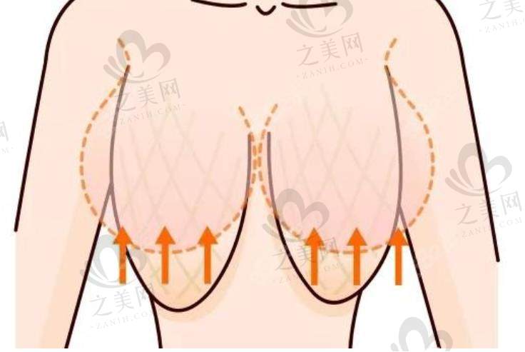 郑州大学第二附属医院正美李钢,4万到8万做磨骨、耳再造、巨乳缩小等手术,安全有保障