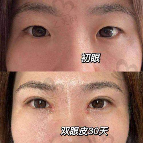成都纯曦医美林靖医生眼整形价格表