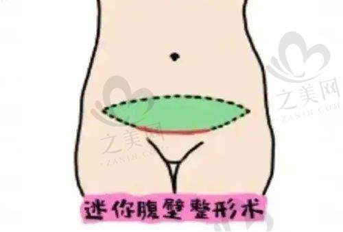 广州Picosure蜂巢皮秒价格区间
