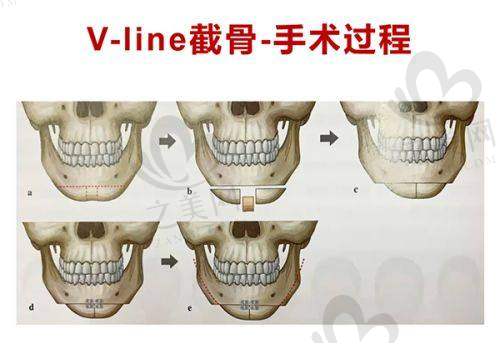 闫迎军迷你mini小切口拉皮手术实例