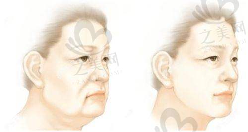 湖南美研医疗美容门诊部怎么样?正规资质技术优,面部填充效果好,服务佳口碑棒值得选