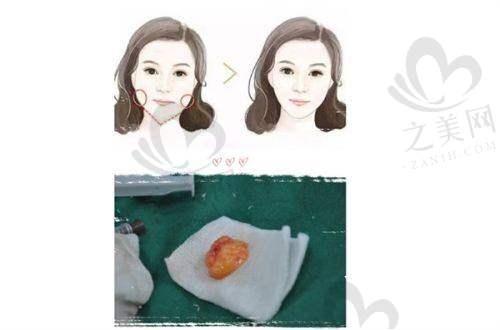 长春常见医院激光祛斑价格区间