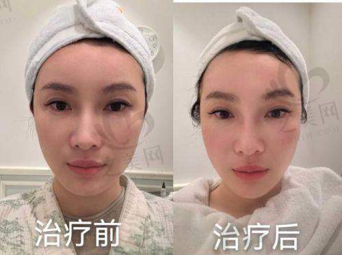 北京上海深圳广州除斑收费标准