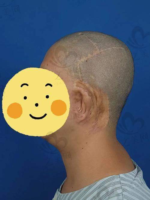余文林医生：耳再造领域的佼佼者