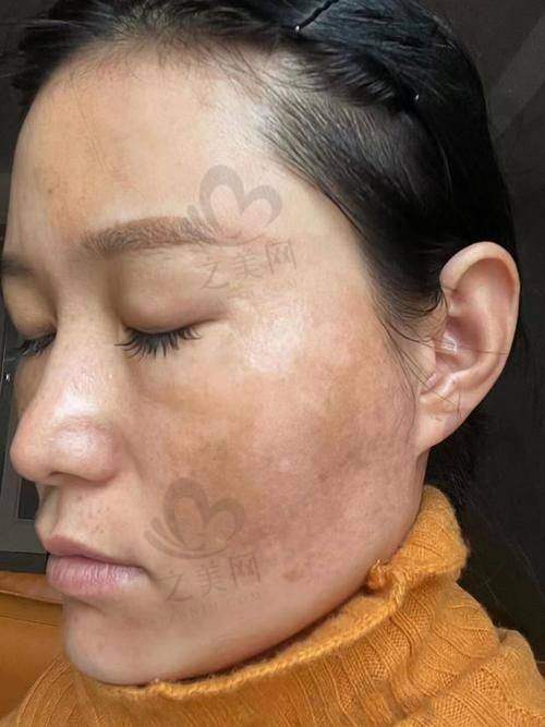 福州部分医院激光祛斑价格实例