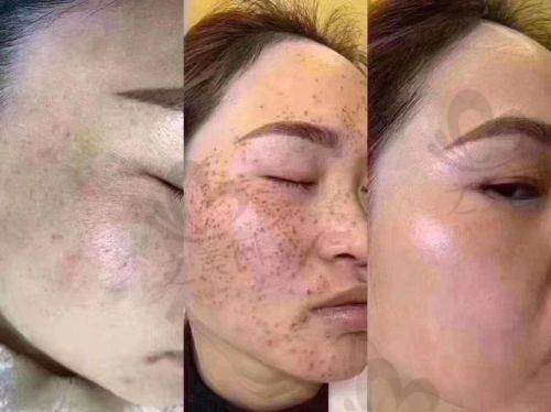 南京皮研所激光科祛斑价格