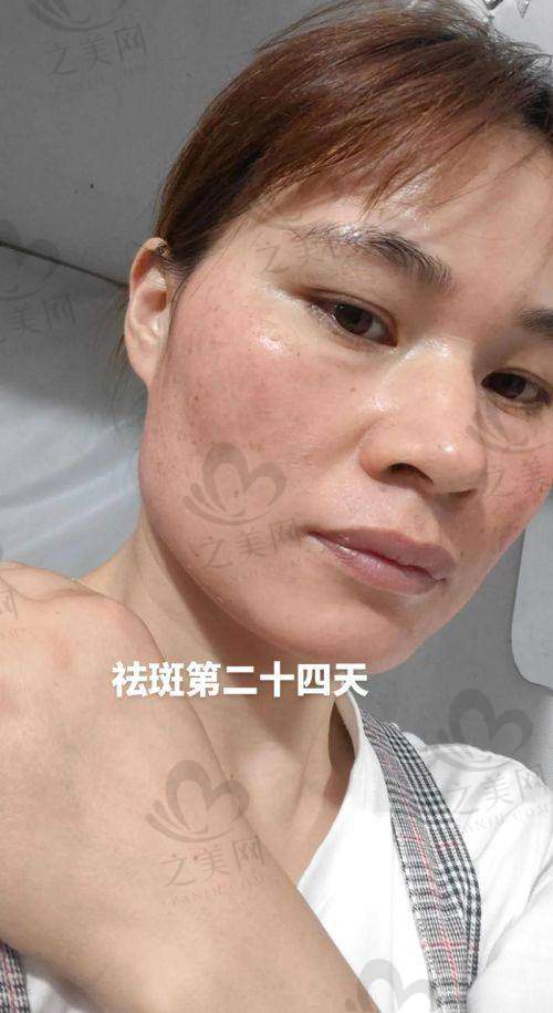 激光祛斑设备对价格和成效的影响