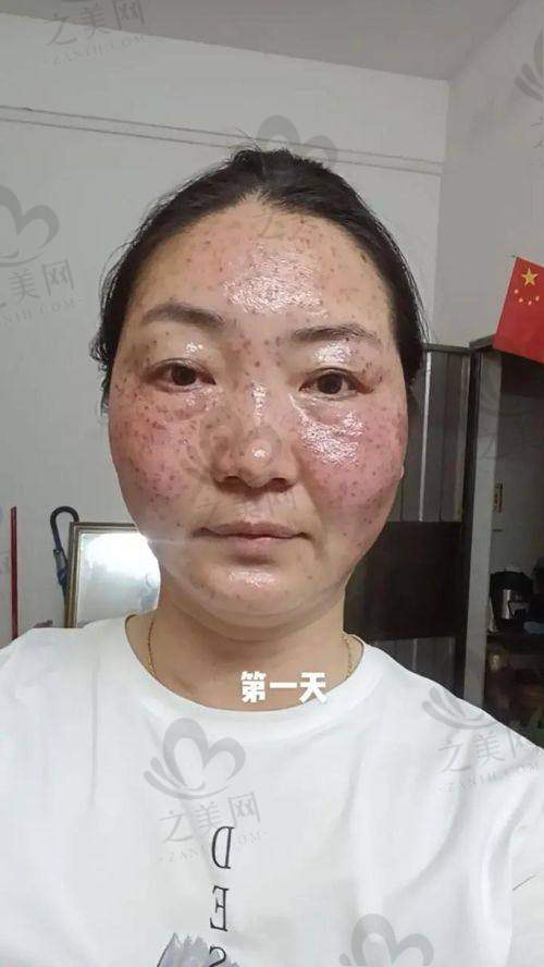 汕头皮肤医院激光祛斑成效