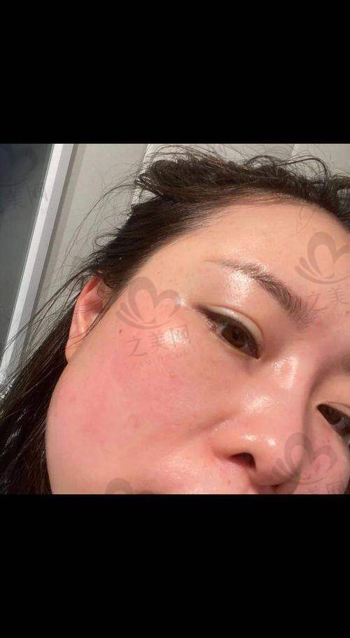 如何选择合适的激光祛斑机构
