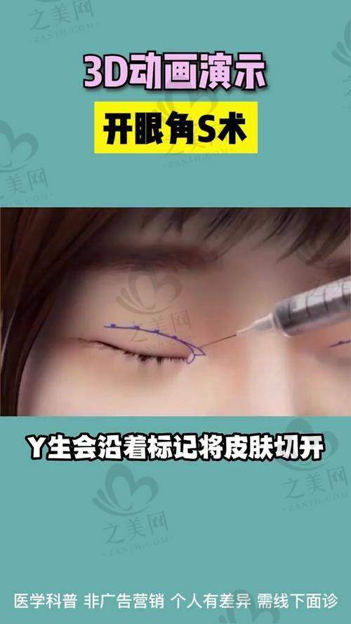 国内内眼角修复手术好的医院排名