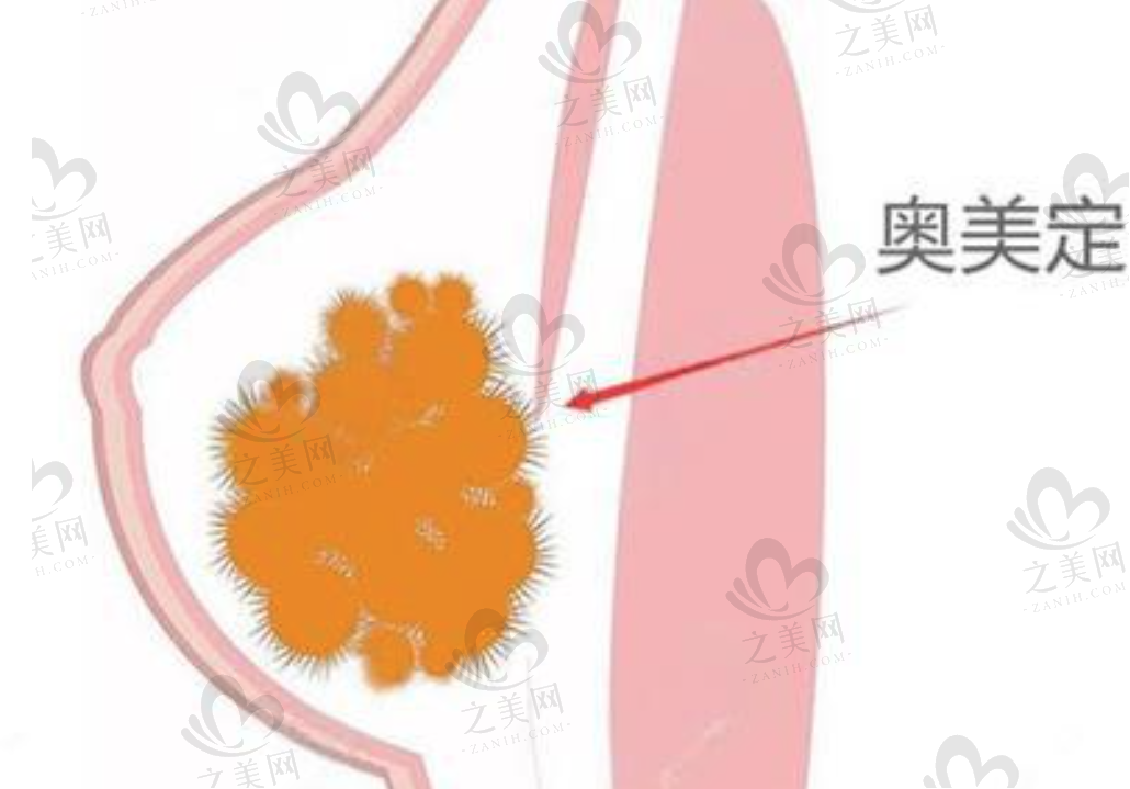 奥美定隆胸取出修复哪家医院做的好?广州(荔医/中家医)、北京(煤医)、上海(华美)等地5家医院技术优势及价格参考