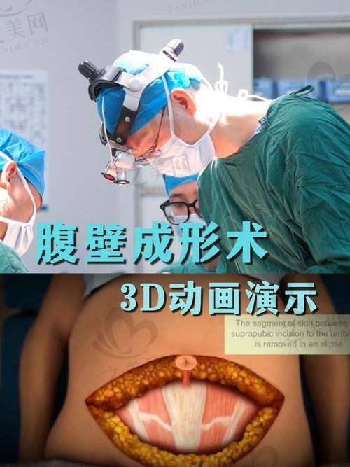 部分其他优质腹壁成型医院