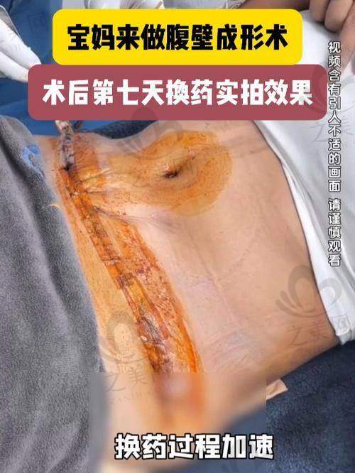 腹壁成型术的作用与难度