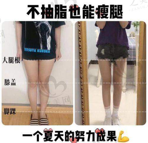 选择西美医院做直腿术的理由
