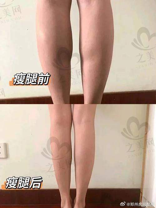 西安西美医院直腿术医生推荐