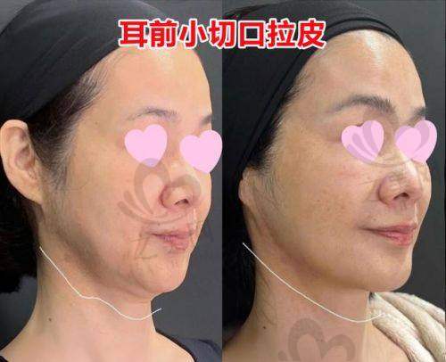 面部提升技术优势明显