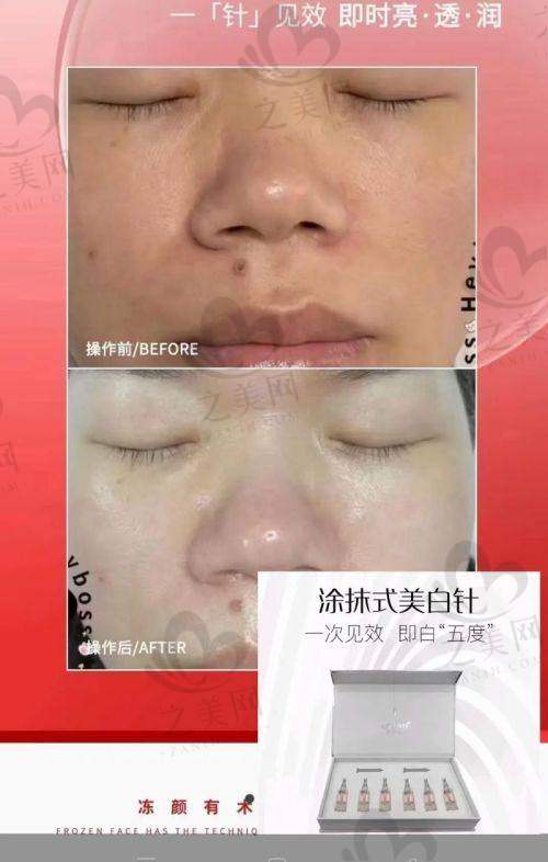 术后3个月成效对比图片及避坑指南