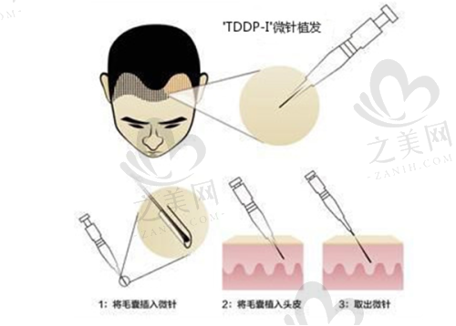 植发价格较合理