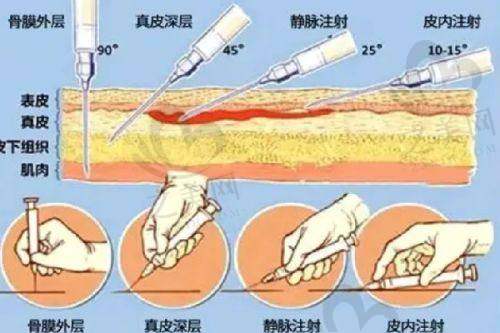 筋膜提升项目