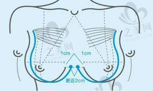 热门项目——隆鼻术
