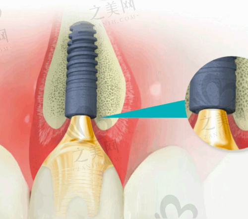 非常后悔做种植牙后口腔健康受影响怎么办