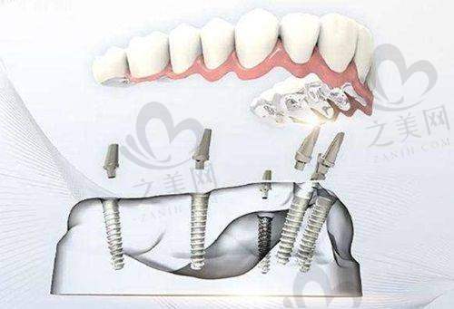 牙博士口腔集团价格与其他口腔机构对比