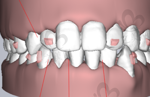 做完种植牙后悔了还能修复原来牙齿吗