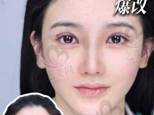 肉条眼修复技术不错