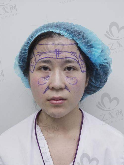 面部填充成效显著