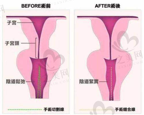 面部提升价目参考