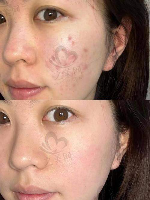 根据黑眼圈情况选择合适价格的熊猫针